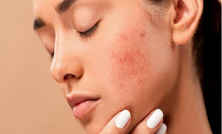 از بین بردن جای جوش با ماسک خانگی + فیلم