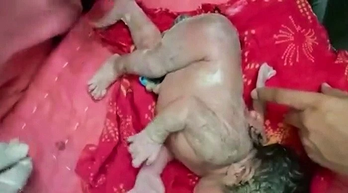 تولد عجیب یک نوزاد با سه دست + عکس