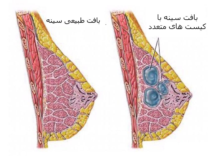 علائم، راه های تشخیصی و درمان پستان فیبروکیستیک