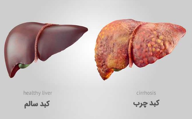 کسانی که کبد چرب دارند این تمرینات ورزشی را انجام دهند