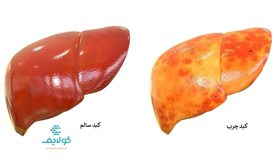 کسانی که کبدچرب دارند می‌توانند لبنیات مصرف کنند؟