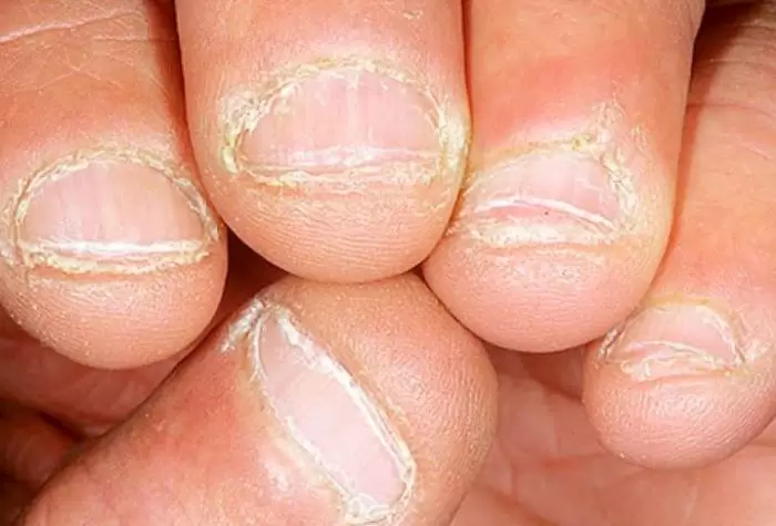 ۱۰ دلیل اصلی شکستگی و نازک شدن ناخن