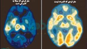 تفاوت مغز یک انسان دارای افسردگی و بدون افسردگی+تصویر