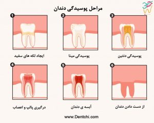 مهم ترین عامل پوسیدگی دندان را بشناسید+تصویر