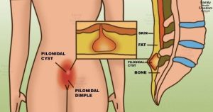 علایم سینوس پایلونیدال یا کیست مویی در کمر+تصویر