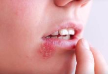 هشدار؛ خطرات جبراان ناپذیر تبخال را جدی بگیرید