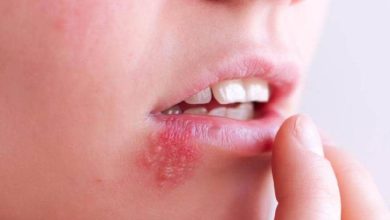 هشدار؛ خطرات جبراان ناپذیر تبخال را جدی بگیرید