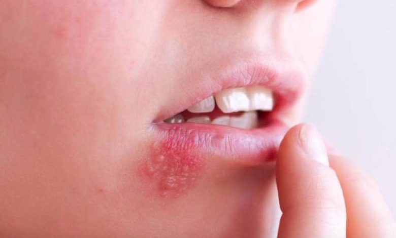 هشدار؛ خطرات جبراان ناپذیر تبخال را جدی بگیرید