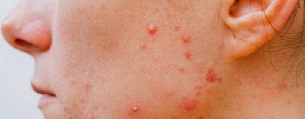 فواید حجامت کردن برای پوست شما چیست؟