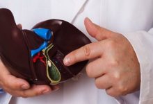 چه بخوریم تا گرفتار سنگ کیسه صفرا نشویم؟