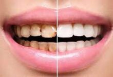 پوسیدگی دندان برگشت‌ناپذیر است؛ چرا باید پیشگیری را جدی بگیریم؟